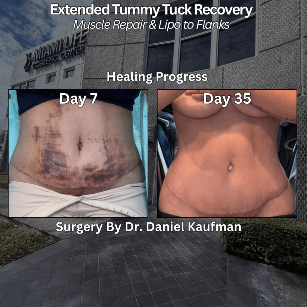 Extended Tummy Tuck Recovery: What I’m Doing to Heal Faster After Muscle Repair and&nbsp;Lipo